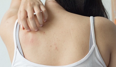 How to Get Rid of Back Acne – 100% PURE